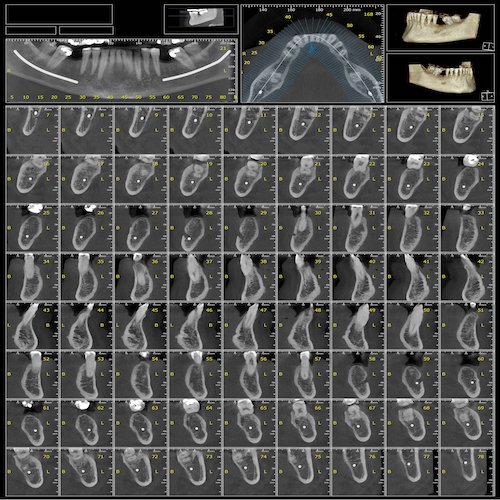 CBCT